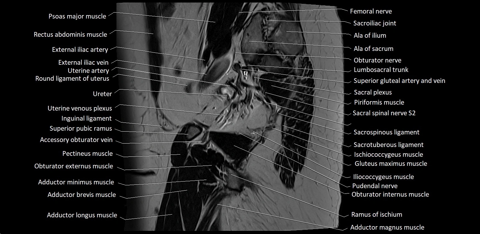Sagittal cross sectional anatomy of female pelvis (MRI 3T) image 35.webp